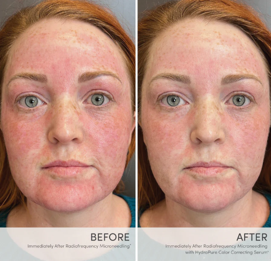 HydroPure Color Correcting Serum with Hyaluronic Acid & CoQ10