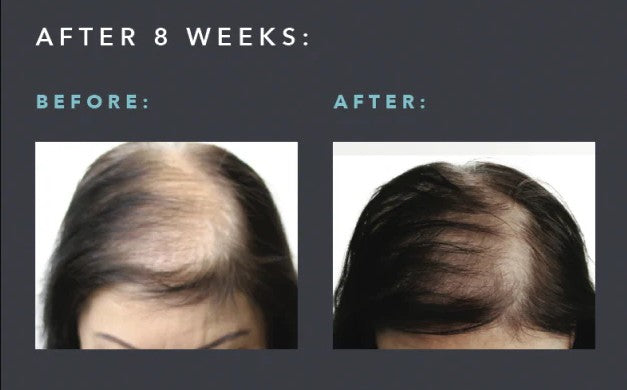 AnteAGE MD Home Hair System